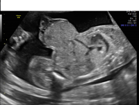 Omphalocele